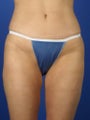 36 Year Old Liposuction of the Abdomen & Medial Thighs