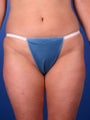 36 Year Old Liposuction of the Abdomen & Medial Thighs
