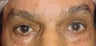 Eyelid Surgery