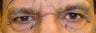 Eyelid Surgery