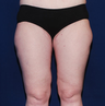 Thigh Lift