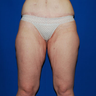 Thigh Lift