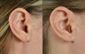 Torn Earlobe Repair