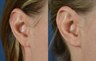 Torn Earlobe Repair