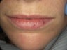 Teeth and Lips for Smile Makeover