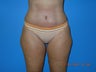 Abdominoplasty