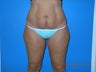 Abdominoplasty