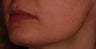Photofacial treatment for Rosacea