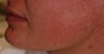 Photofacial treatment for Rosacea