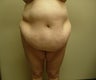 Massive Weight Loss Plastic Surgery