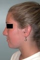 Rhinoplasty