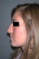 Rhinoplasty