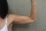 Arm Lift