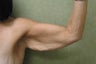 Arm Lift