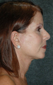 Facelift