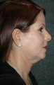 Facelift