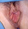 Labiaplasty