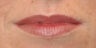 Juvederm for Lips