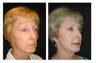 Liquid Facelift 