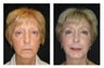 Liquid Facelift 