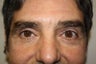 Eyelid Surgery