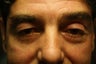 Eyelid Surgery