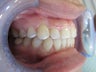 Edge to edge bite, when it damages your teeth and makes you look older