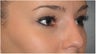 Non Surgical Nose Job