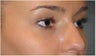 Non Surgical Nose Job