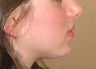 chin augmentation / enlargment