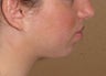chin augmentation / enlargment