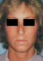 Revision Rhinoplasty