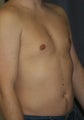 Liposuction