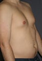 Liposuction