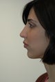 Rhinoplasty
