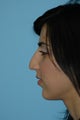 Rhinoplasty