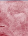 IPL Treatment for Rosacea