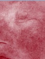 IPL Treatment for Rosacea