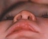 Infant who underwent surgery for a cleft lip and palate 