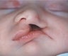 Infant who underwent surgery for a cleft lip and palate 