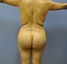 Brazilian Butt Lift