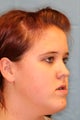 Female Treated for  Maxillary Hypoplasia and Mandibular Hyperplasia