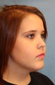 Female Treated for  Maxillary Hypoplasia and Mandibular Hyperplasia