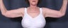  Arm Lift