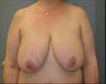 Breast, Breast Lift, Breast Reduction, Mastopexy 