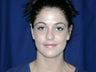 Otoplasty