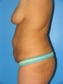 Body Lift