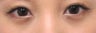 Bilateral Lower Blepharoplasty