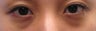 Bilateral Lower Blepharoplasty
