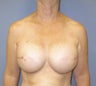 Breast Reconstruction